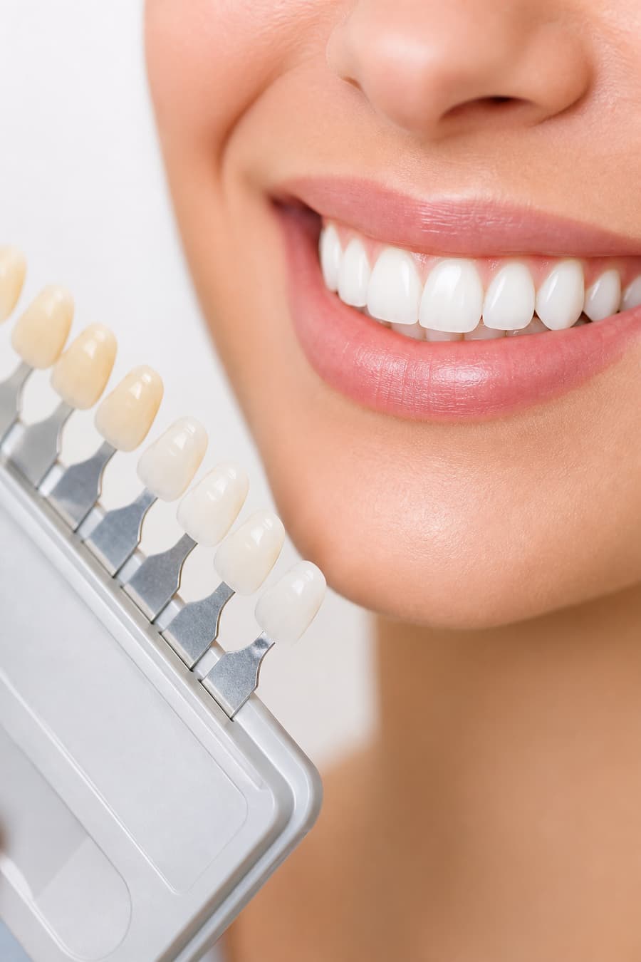 Teeth whitening shade guide beside a bright healthy smile